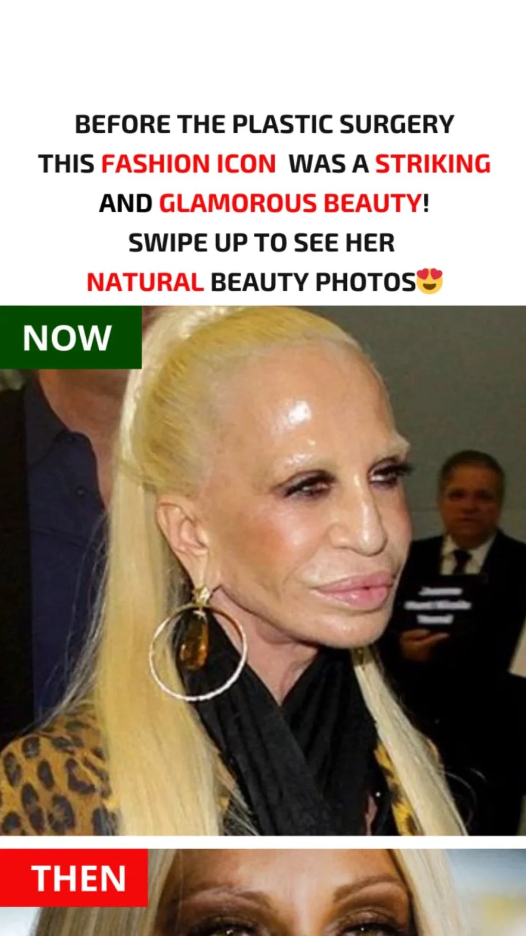 Donatella Versace Before and After Plastic Surgery