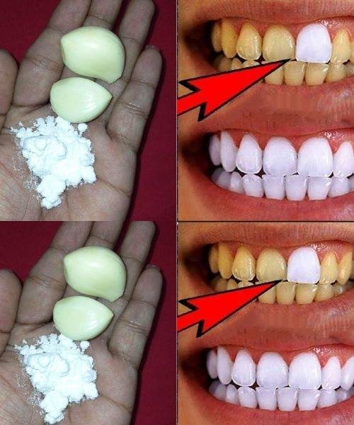 Garlic: A Surprising Ingredient for Making Teeth Whiter