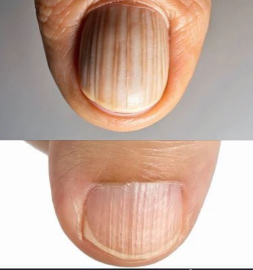 Having Striped Nails Could Mean That Your Body Is…